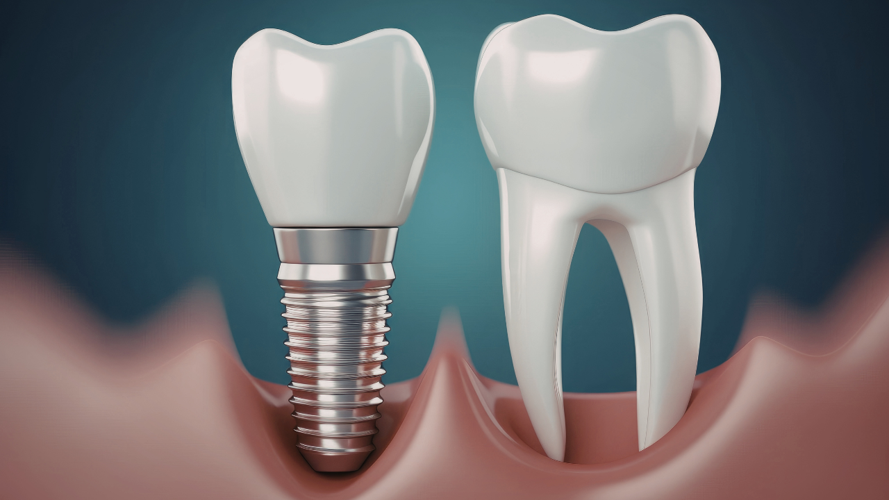 Exemplo de implante dentario unitario